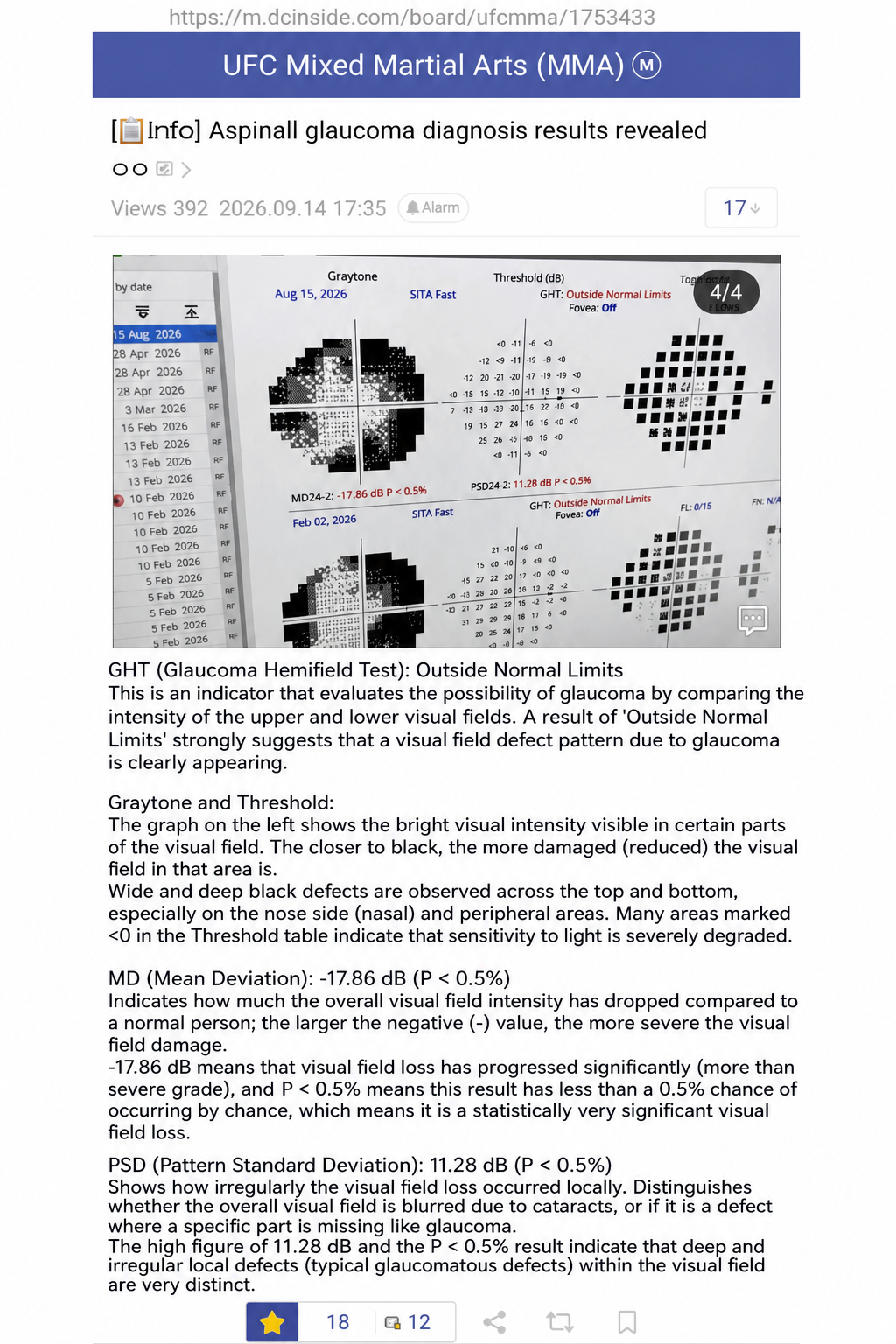 Screenshot of Tom Aspinall's glaucoma diagnosis and visual field test results shared on an online community.