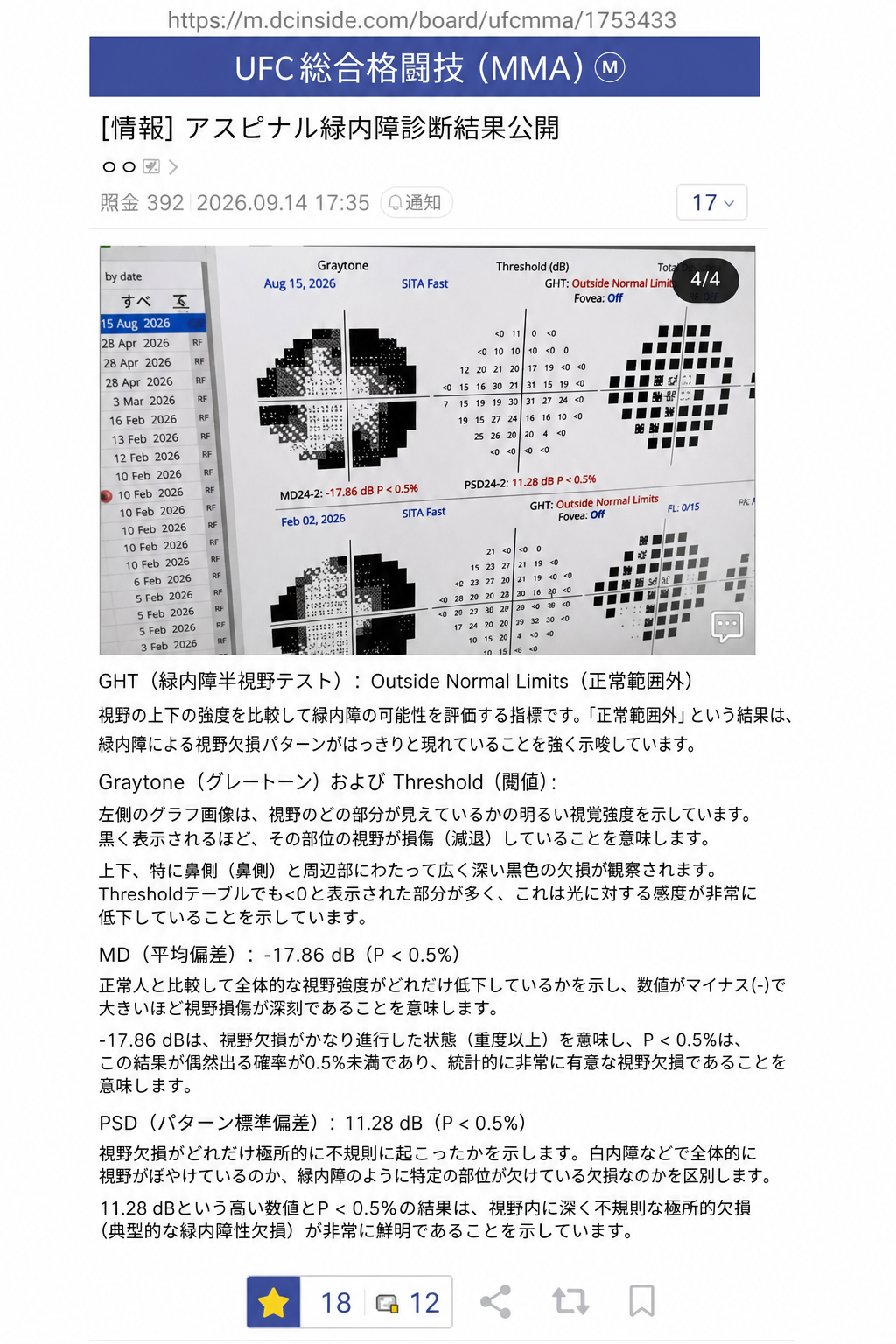 オンラインコミュニティで共有されたトム・アスピナルの緑内障診断書および視野検査結果のスクリーンショット